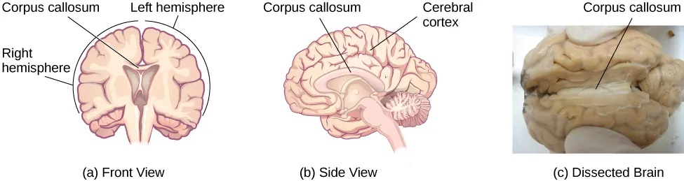 Illustrations (a) and (b) show the corpus callosum’s location in the brain in front and side views. Photograph (c) shows the corpus callosum in a dissected brain.