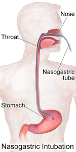 Nasogastric intubation; nasogastric tube inserted through the nose and down the throat to the stomach