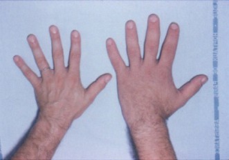 image of persons hand with Acromegaly