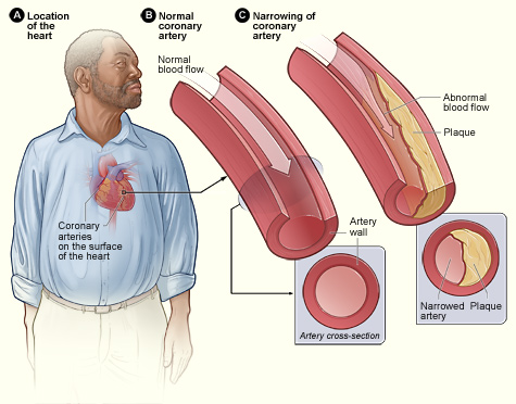 types of type of arteriosclerosis