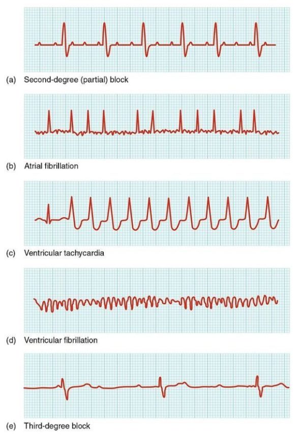 ECG images of various heart rhythms