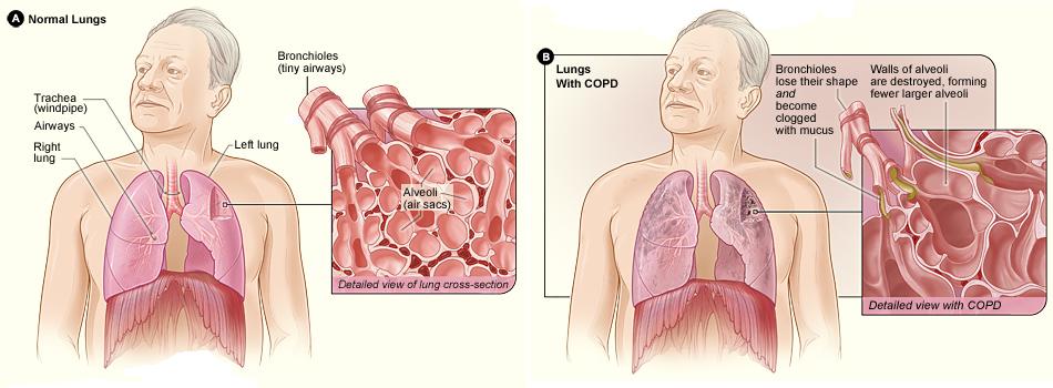 image of normal lungs and lungs with COPD