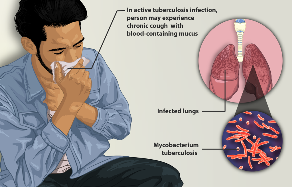 image of person with Tuberculosis (TB)