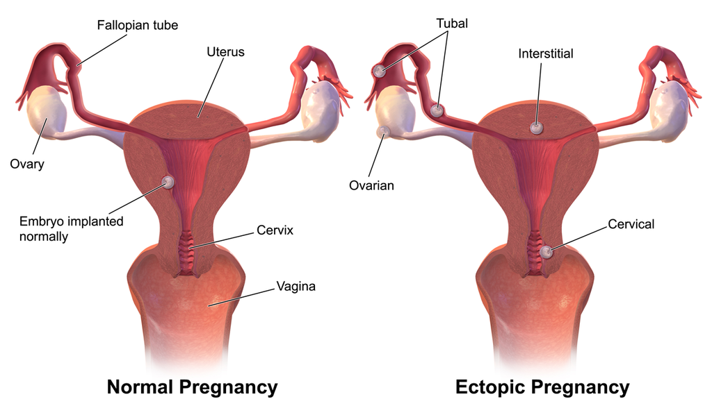normal and ectopic pregnancy