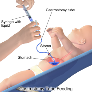 Gastrostomy tube feeding; baby lying down with gastronomy tube attached to syringe with liquid Tube inserted through the stoma and into the stomach