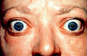 eyes of someone with exophthalmic goiter