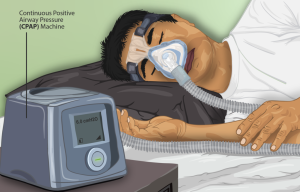 sleep apnea machine