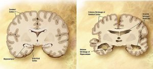 healthy brain and brain with Alzheimer’s disease