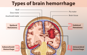 examples of hemorrhages in the brain