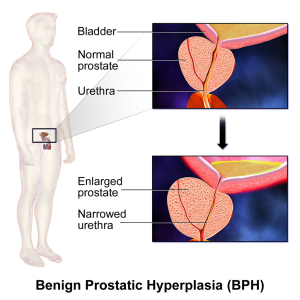 image of benign prostatic hyperplasia (BPH)