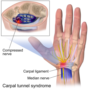 image of Carpal tunnel syndrome