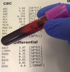 tube of blood with CBC results behind it