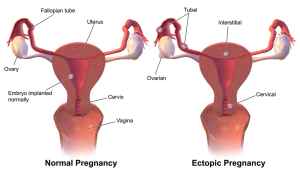 image of normal pregnancy and an ectopic pregnancy
