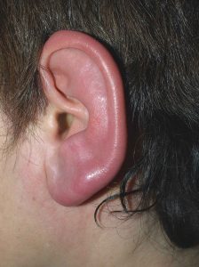 ear that is inflamed