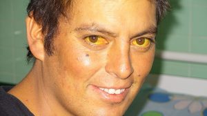 image of a person with Jaundice