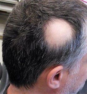 image of Alopecia on the head