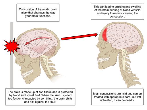 image of what happens if someone has a concussion