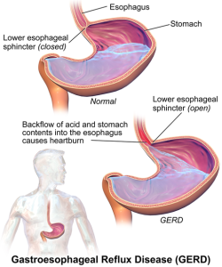 image gastroesophageal reflux disease