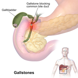 Cholelithiasis (gallstones)