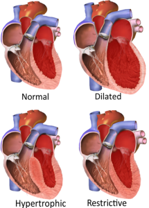 shows various forms of cardiomyopathy