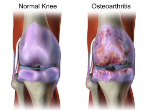 normal knee and knee with osteoarthritis