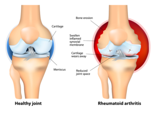 Healthy joint and Rheumatoid arthritis (RA)