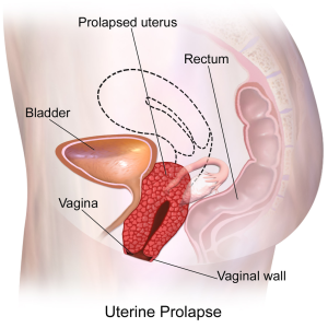 prolapse of the uterus