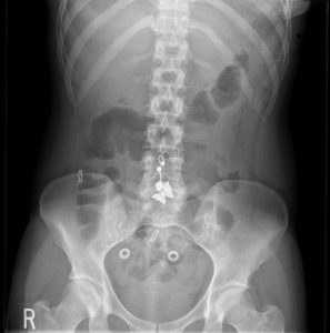 normal abdominal X-ray; however, you can see the presence of artifacts—a bellybutton piercing and buttons on the patient's clothing