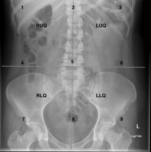 normal abdominal X-rays
