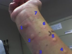 skin test to the arm demonstrating the red, and raised, reaction that can occur