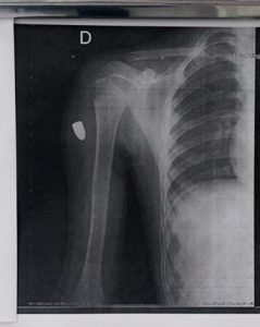 pediatric patient with a bullet in their arm