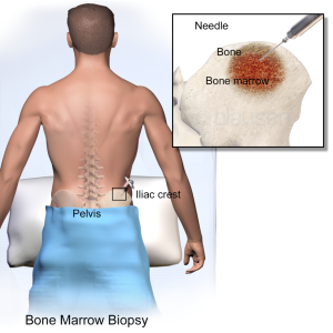 shows where a bone marrow sample is taken
