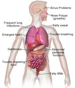 image of body showing effects of cystic fibrosis