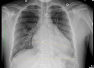 chest x-ray with enlarged heart