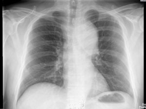 chest x-ray