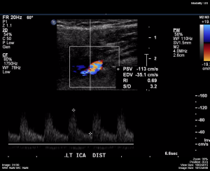 Doppler ultrasound