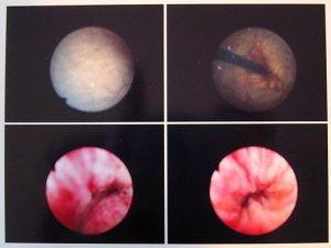 images of cystoscopy