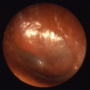 What you see during Otoscopy