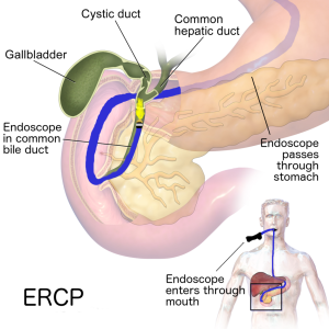 Endoscopic retrograde cholangiopancreatography (ERCP) being performed