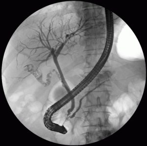 what Endoscopic retrograde cholangiopancreatography (ERCP) might look like