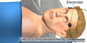 electroconvulsive thearapy