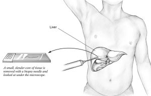 shows how a liver biopsy is performed