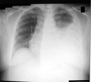 chest X-ray of a patient who requires a thoracentesis for pleural effusion