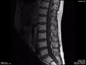 detailed MRI scan of the lumbar spine