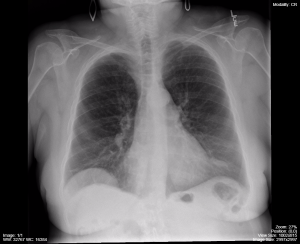 the lower portions of both lung are collapsed on chest x-ray