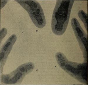 early X-rays taken by Röntgen