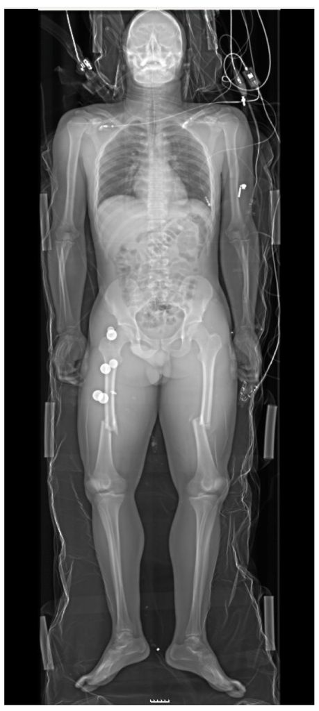 full-body X-ray of a patient with bilateral femur fractures