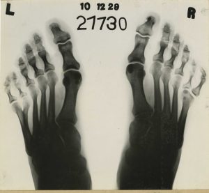 image of polydactyly