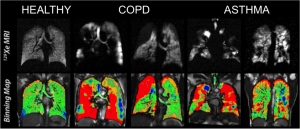 MRI showing the difference between healthy lungs, COPD lungs, and lungs affected by asthma.