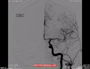 cardiac angiogram image